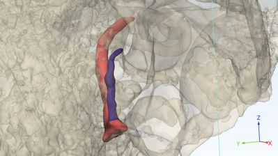 3D visualization of temporal bone with cholesteatoma