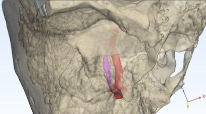Temporal bone tumor 3D model