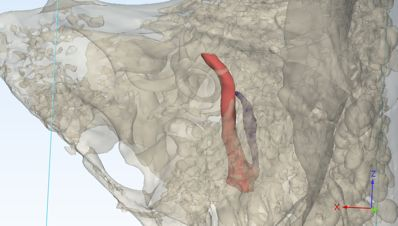 Lateral view of cholesteatoma pathway
