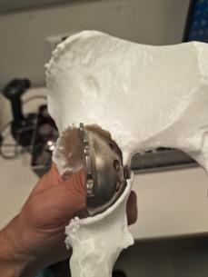 3D printed pelvis with hip implant inserted