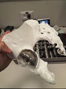 Pelvis model with implant - front view