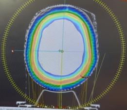 CT scan with bolus radiation planning