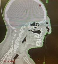 CT sagittal view with bolus placement