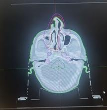 CT scan with radiation dose mapping