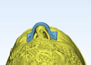 3D model with blue nasal bolus on head