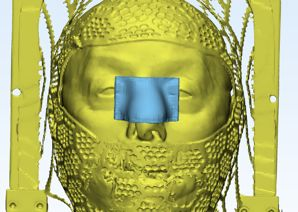 3D scan with radiotherapy mask overlay