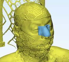 3D scan with bolus design on face
