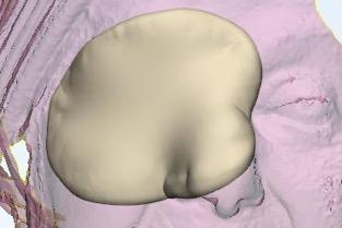 3D tumor model for radiation planning