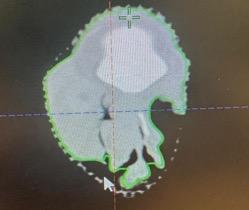 CT scan with treatment volume overlay