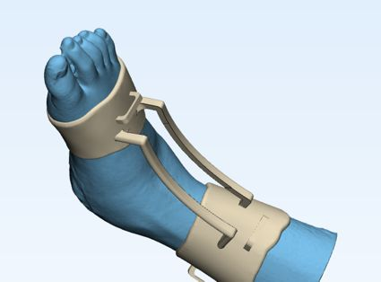 CAD design of custom ankle splint on 3D scan