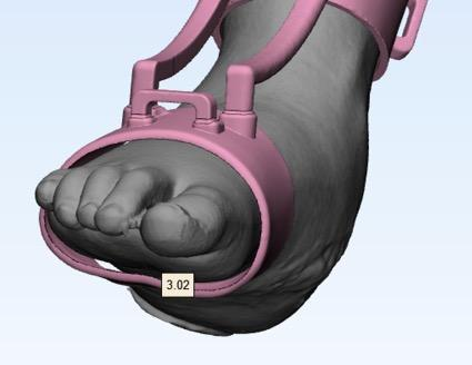 3D designed foot orthotic device