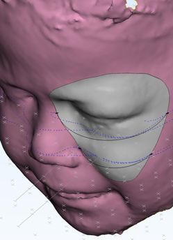 3D facial scan with protective device design overlay