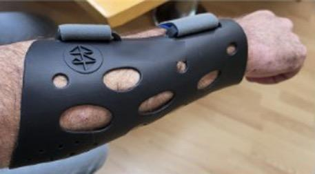 Forearm splint fitted on patient